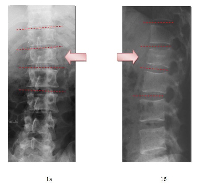Рентгенограммы позвоночника пациента при поступлении в прямой (а) и боковой (б) проекциях. Определяется компрессионный перелом тела первого поясничного позвонка с кифосколиотической деформацией на данном уровне.