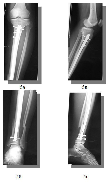 Рентгенограммы костей левой голени в прямой